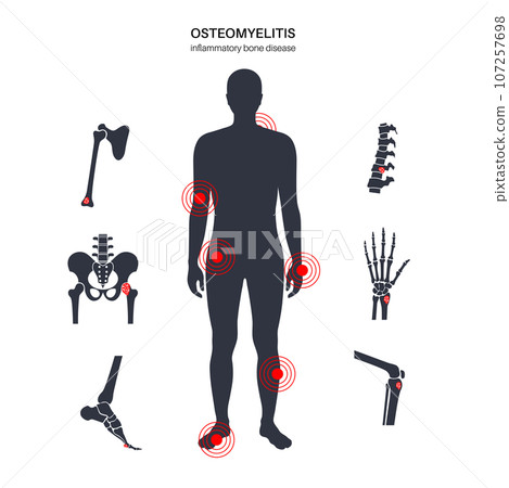 Osteomyelitis in adults Osteomyelitis in adults 107257698