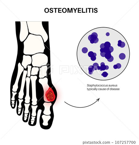 Osteomyelitis of feet 107257700