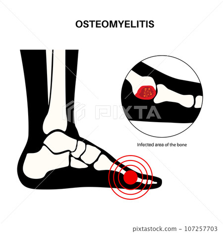 Osteomyelitis of feet Osteomyelitis of feet 107257703