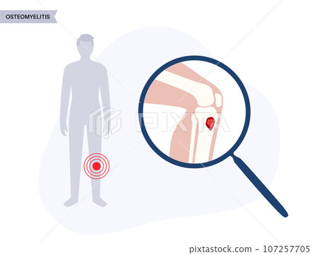 Tibia bone osteomyelitis Tibia bone osteomyelitis 107257705