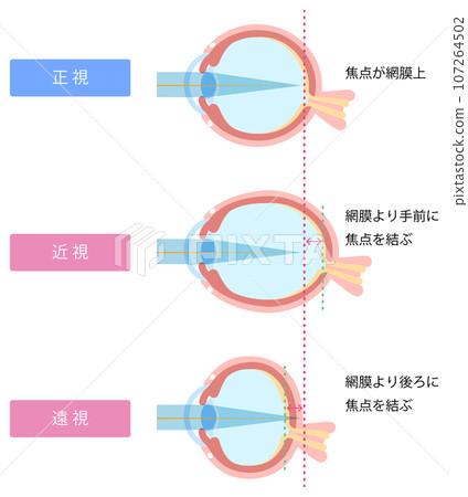 正視、近視和遠視的區別圖解 107264502