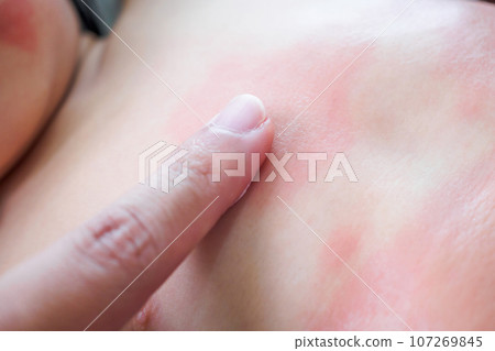 Doctor hand applying topical antihistamine medicine cream on little girl body with severe skin rash and allergy 107269845