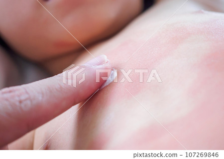 Doctor hand applying topical antihistamine medicine cream on little girl body with severe skin rash and allergy 107269846