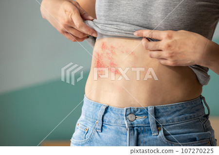 Painful shingles in woman 107270225