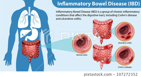 Inflammatory Bowel Disease (IBD) Infographic Inflammatory Bowel Disease (IBD) Infographic 107272352