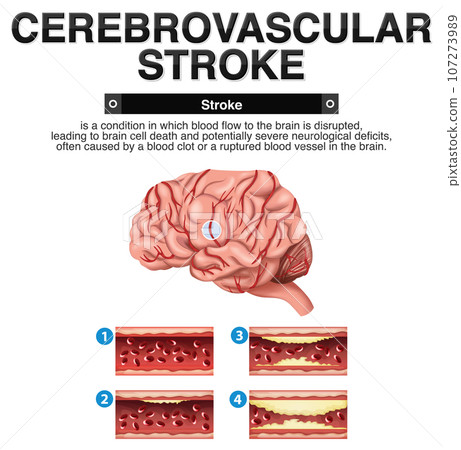 Informative poster of Cerebrovascular stroke 107273989