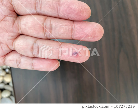 Hematoma formation Hematoma formation 107275239