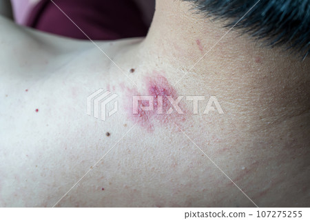Skin disease Skin disease 107275255