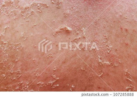 Psoriatic eczema is disease characterized by skin problems inflammation. Psoriatic eczema is disease characterized by skin problems inflammation. 107285888