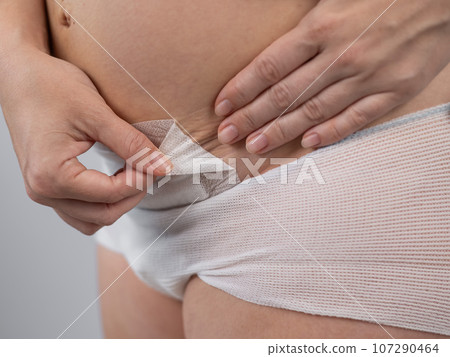 A woman tears a patch from a stitch after a caesarean section. 107290464