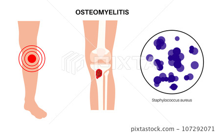 Tibia bone osteomyelitis 107292071