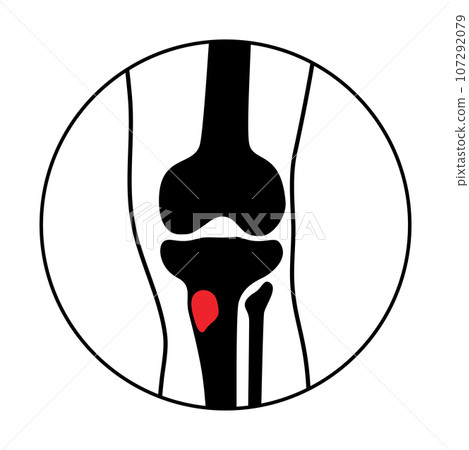 Tibia bone osteomyelitis Tibia bone osteomyelitis 107292079