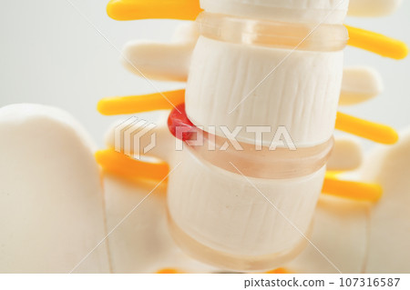 Spinal nerve and bone, Lumbar spine displaced herniated disc fragment, Model for treatment medical in the orthopedic department. 107316587