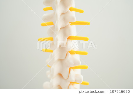Spinal nerve and bone, Lumbar spine displaced herniated disc fragment, Model for treatment medical in the orthopedic department. 107316650