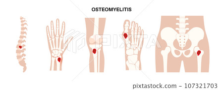 Osteomyelitis disease poster Osteomyelitis disease poster 107321703
