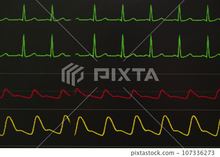 Monitoring displays of patient vital signs 107336273