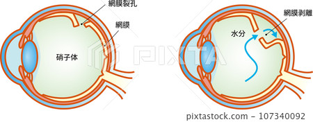Eye symptoms from retinal tear to retinal detachment Eye symptoms from retinal tear to retinal detachment 107340092