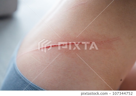 spray antiseptic on the wound on the child's back. disinfection of wounds. hydrogen peroxide spray. spray antiseptic on the wound on the child's back. disinfection of wounds. hydrogen peroxide spray. 107344752