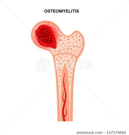 Osteomyelitis of hip Osteomyelitis of hip 107379680