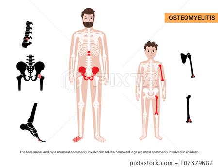 Osteomyelitis in child and adult Osteomyelitis in child and adult 107379682