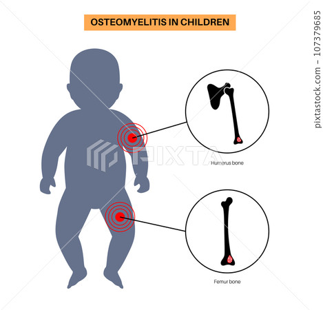 Osteomyelitis in children 107379685