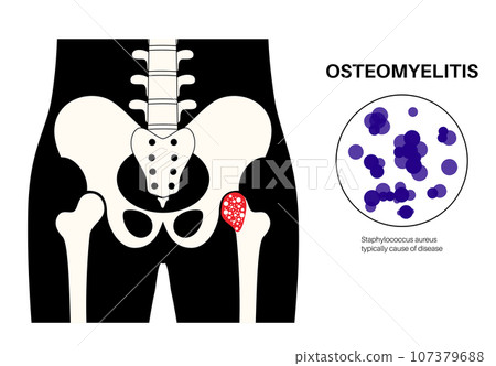 Osteomyelitis of hip Osteomyelitis of hip 107379688