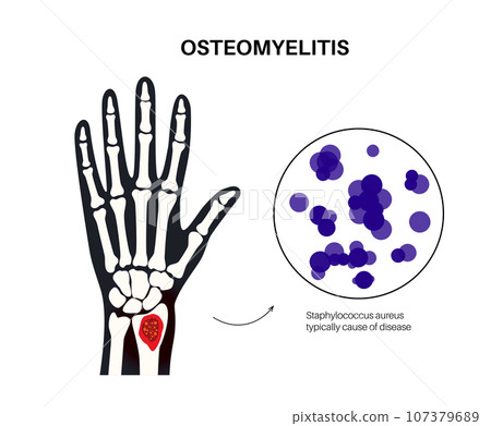 Osteomyelitis of arm 107379689