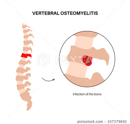 Vertebral osteomyelitis poster Vertebral osteomyelitis poster 107379692