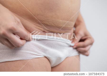 A woman shows off a fresh scar from a caesarean section. A woman shows off a fresh scar from a caesarean section. 107384373