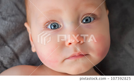 Baby girl with allergic reaction on cheeks looks with surprise Baby girl with allergic reaction on cheeks looks with surprise 107392825