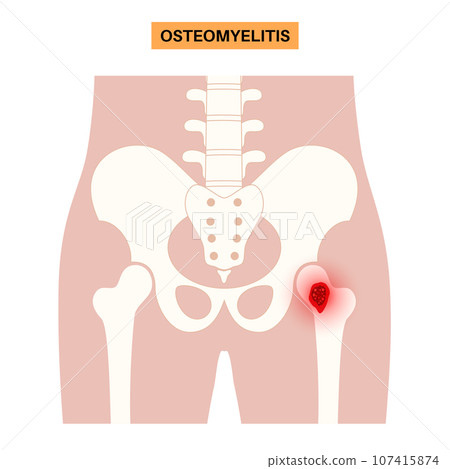 Osteomyelitis of hip 107415874