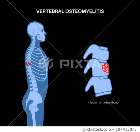 Vertebral osteomyelitis poster 107415875