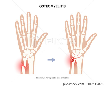 Osteomyelitis of arm 107415876