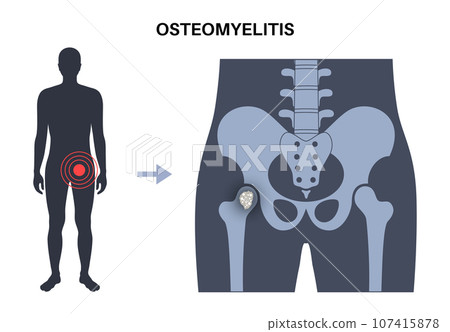 Osteomyelitis of hip 107415878