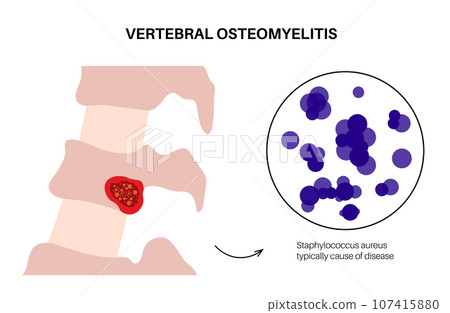 Vertebral osteomyelitis poster 107415880