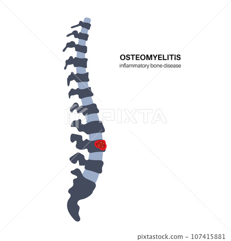 Vertebral osteomyelitis poster Vertebral osteomyelitis poster 107415881