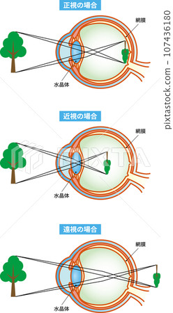 Emmetropia, myopia, hyperopia, eye structure with text 107436180