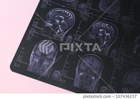 MRI or magnetic resonance imaging of the head and brain. Close up MRI or magnetic resonance imaging of the head and brain. Close up 107436237