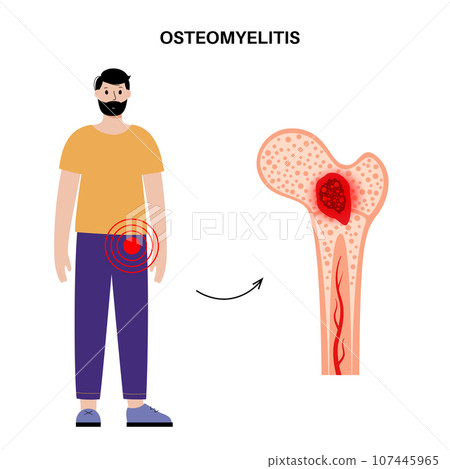 Osteomyelitis of hip 107445965