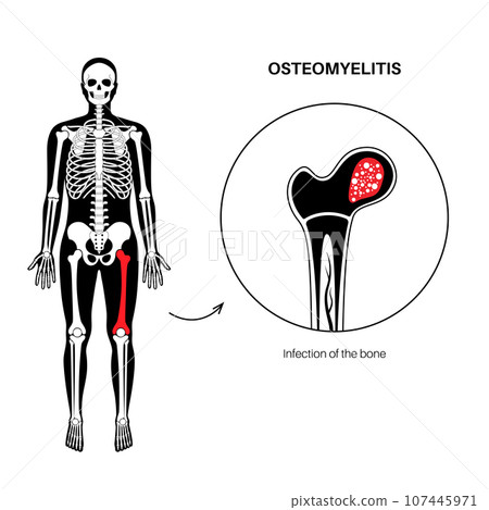 Osteomyelitis of hip Osteomyelitis of hip 107445971