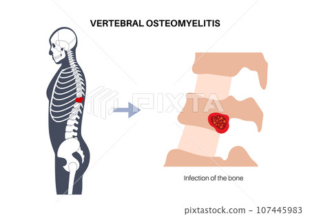 Vertebral osteomyelitis poster Vertebral osteomyelitis poster 107445983