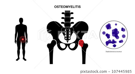Osteomyelitis of hip 107445985