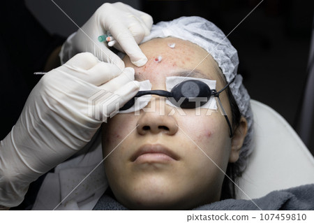 Asian teenage woman have acne,removing pimple spot,squeezing blackhead on face with a dermatologist in beauty clinic,pressing on skin with pimple extractor tool,skin problem,facial treatment,skin care Asian teenage woman have acne,removing pimple spot,squeezing blackhead on face with a dermatologist in beauty clinic,pressing on skin with pimple extractor tool,skin problem,facial treatment,skin care 107459810