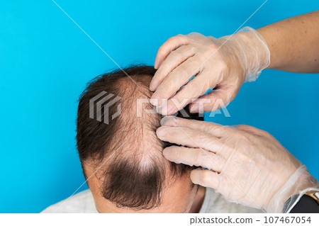 Baldness, a man is examined by a doctor in gloves on a blue background close-up. Baldness, a man is examined by a doctor in gloves on a blue background close-up. 107467054