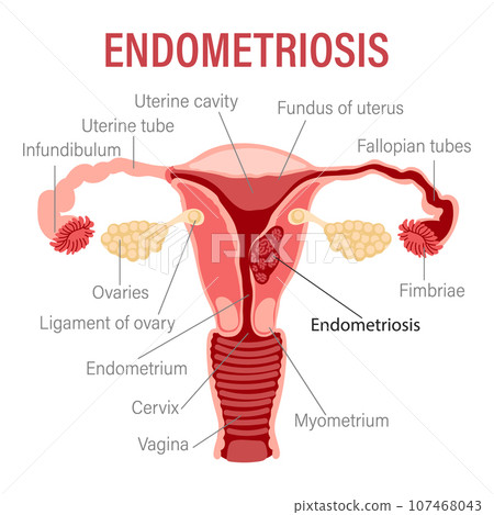 Endometriosis, schematic illustration of the uterus, diseases of the female reproductive system. Medical infographic banner. Vector 107468043