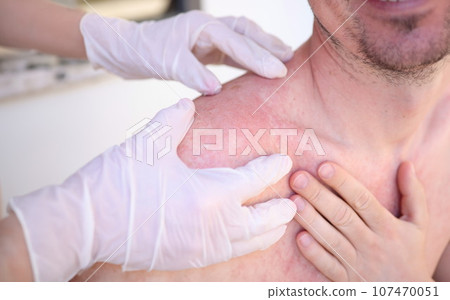 Doctor in gloves conducts initial examination of man with sunburn on skin of his shoulders and back 107470051