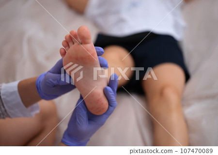 Infectious disease doctor examining rash on skin of child feet closeup 107470089