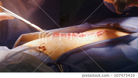Professional surgeon stitches cut using medical clip and tweezers Professional surgeon stitches cut using medical clip and tweezers 107473410