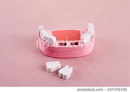 Teeth loss concept. Wooden jaw model with missing or extracted tooth Teeth loss concept. Wooden jaw model with missing or extracted tooth 107476780