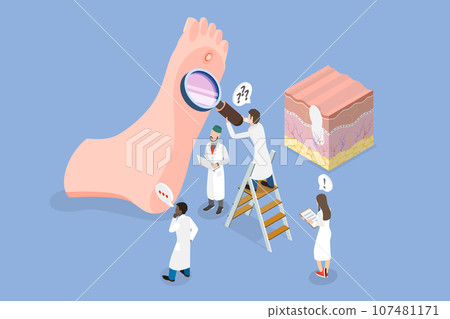 3D Isometric Flat Vector Conceptual Illustration of Foot Wart 107481171